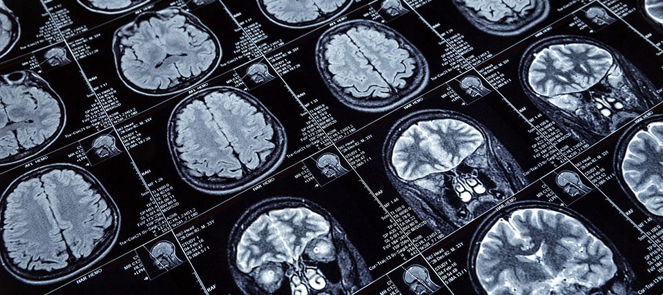 Grid of brain MRI scan images