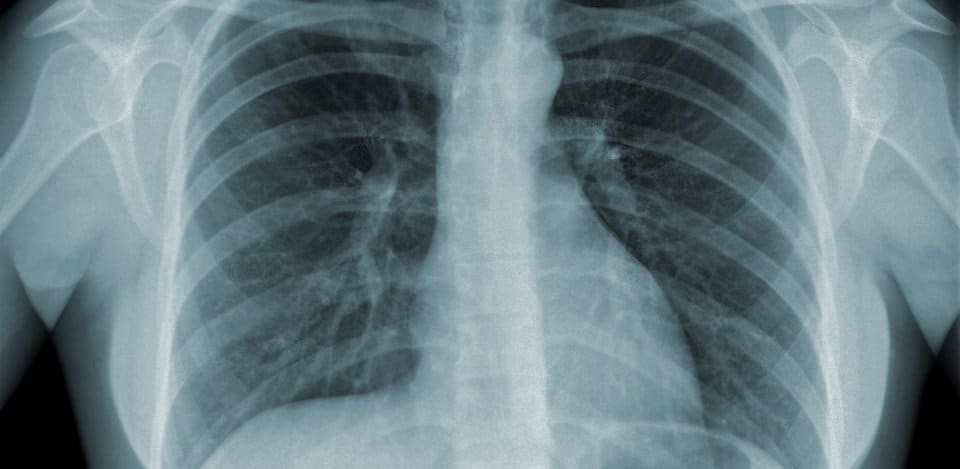 Chest X-ray image showing lungs
